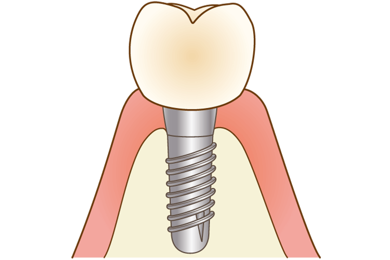インプラント