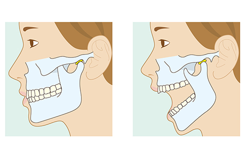 顎関節症