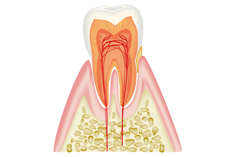 軽度歯周病（歯肉炎・歯周炎）