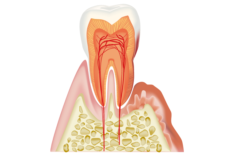 中度歯周病（歯周炎）
